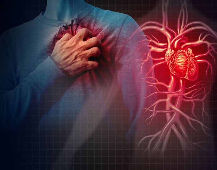 Риск инсульта у пациентов с сердечной недостаточностью со сниженной фракцией выброса левого желудочка после инфаркта миокарда, без фибрилляции предсердий